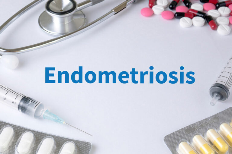 Endometriosis – Symptoms and natural remedies